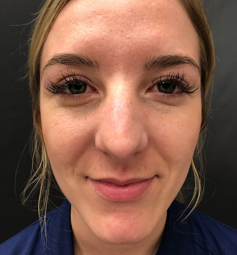 Rhinoplasty Before & After Gallery - Patient 417796 - Image 3