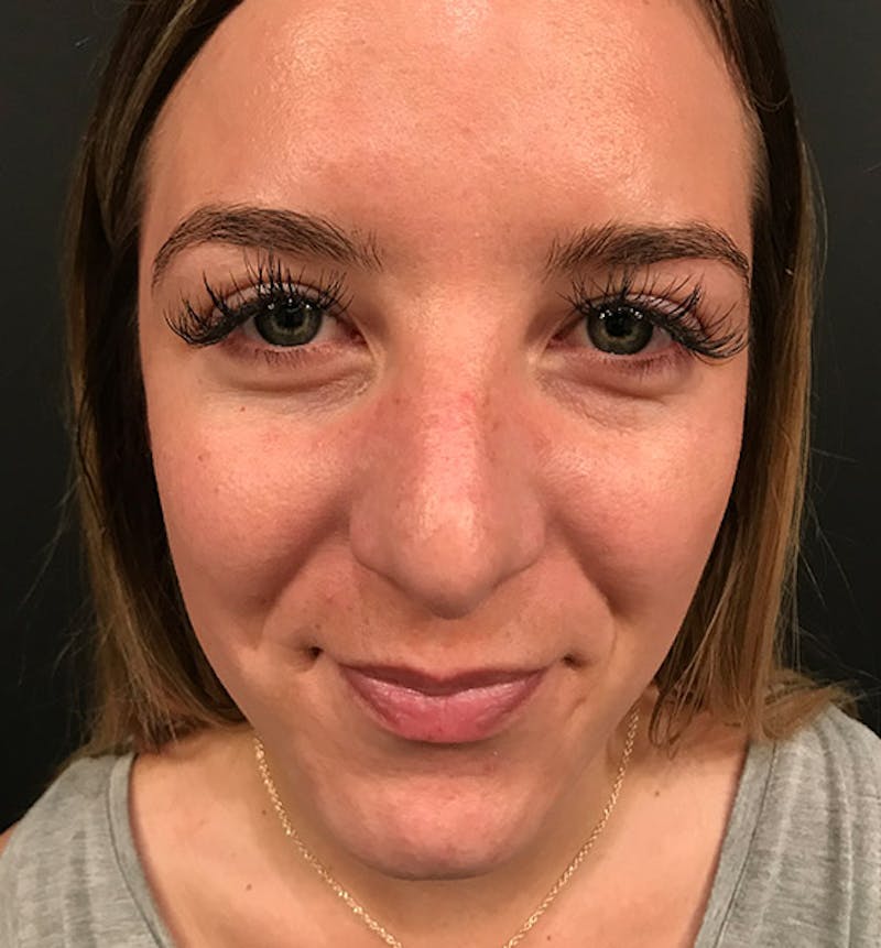 Rhinoplasty Before & After Gallery - Patient 417796 - Image 4
