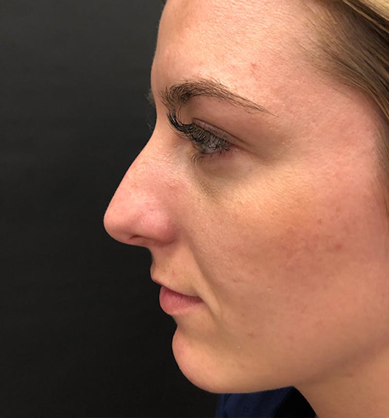 Rhinoplasty Before & After Gallery - Patient 417796 - Image 5