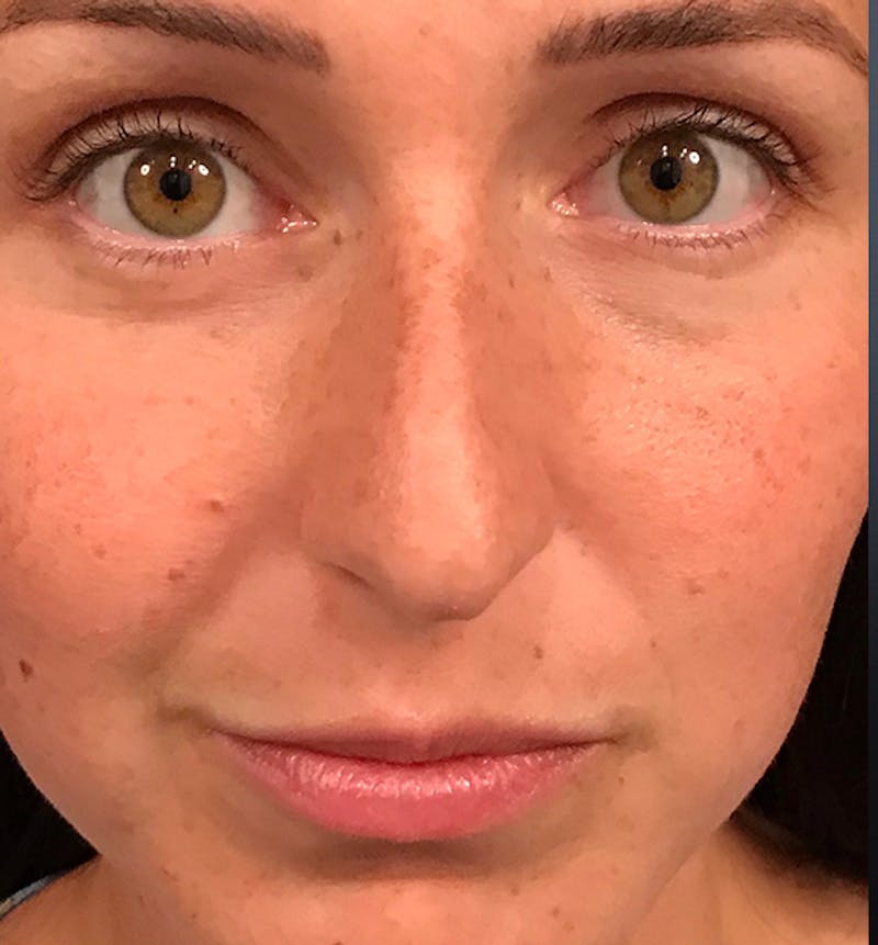 Rhinoplasty Before & After Gallery - Patient 429138 - Image 3