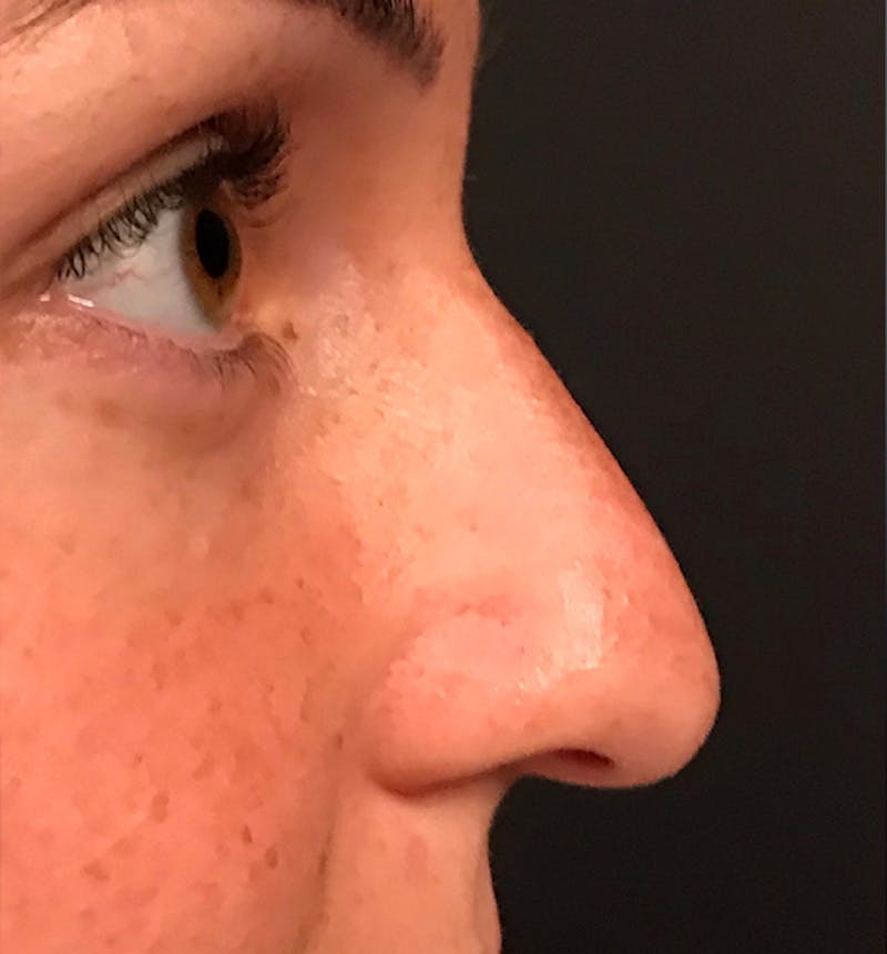 Rhinoplasty Before & After Gallery - Patient 429138 - Image 5