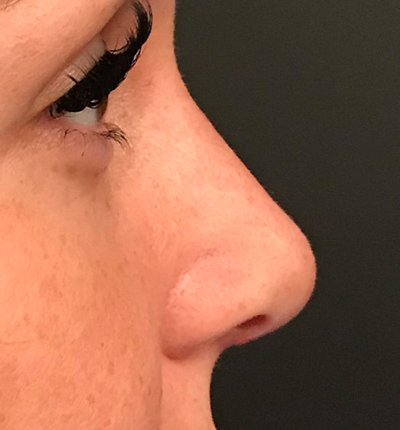 Rhinoplasty Before & After Gallery - Patient 429138 - Image 6