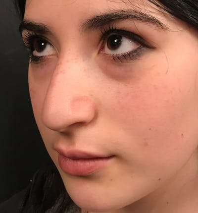 Rhinoplasty Before & After Gallery - Patient 362877 - Image 1