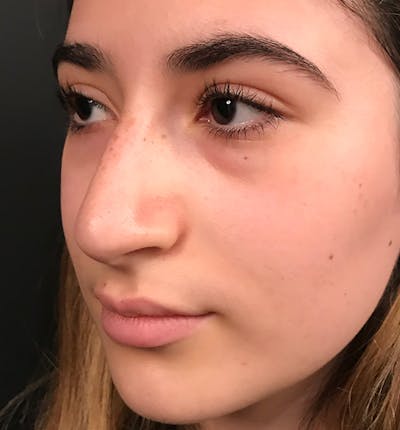 Rhinoplasty Before & After Gallery - Patient 982945 - Image 1