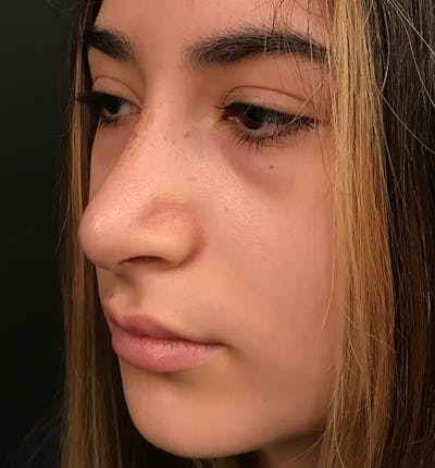 Rhinoplasty Before & After Gallery - Patient 982945 - Image 2