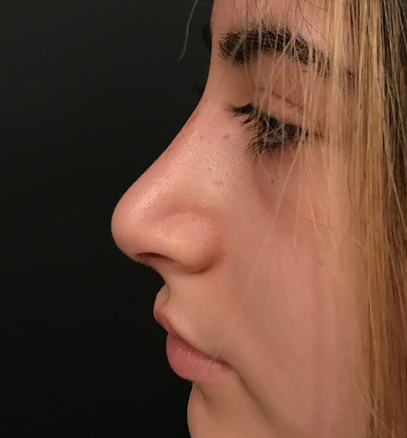 Rhinoplasty Before & After Gallery - Patient 982945 - Image 4