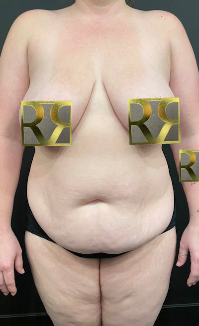 Plus Size Tummy Tuck: Early Recovery Before & After Gallery - Patient 341107 - Image 1