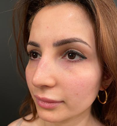 Rhinoplasty Before & After Gallery - Patient 115824 - Image 1