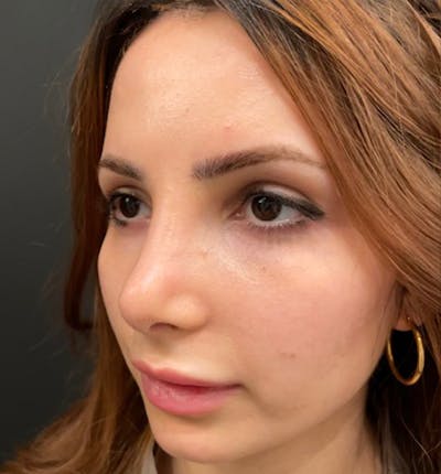 Rhinoplasty Before & After Gallery - Patient 115824 - Image 2