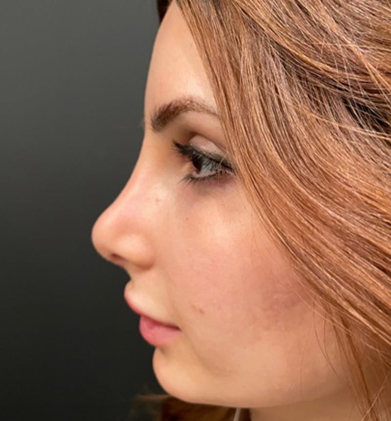 Rhinoplasty Before & After Gallery - Patient 115824 - Image 4