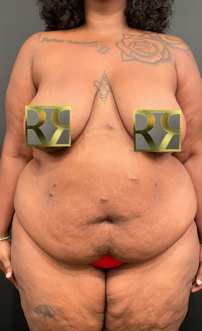 Plus Size Tummy Tuck: Early Recovery Before & After Gallery - Patient 196254 - Image 1