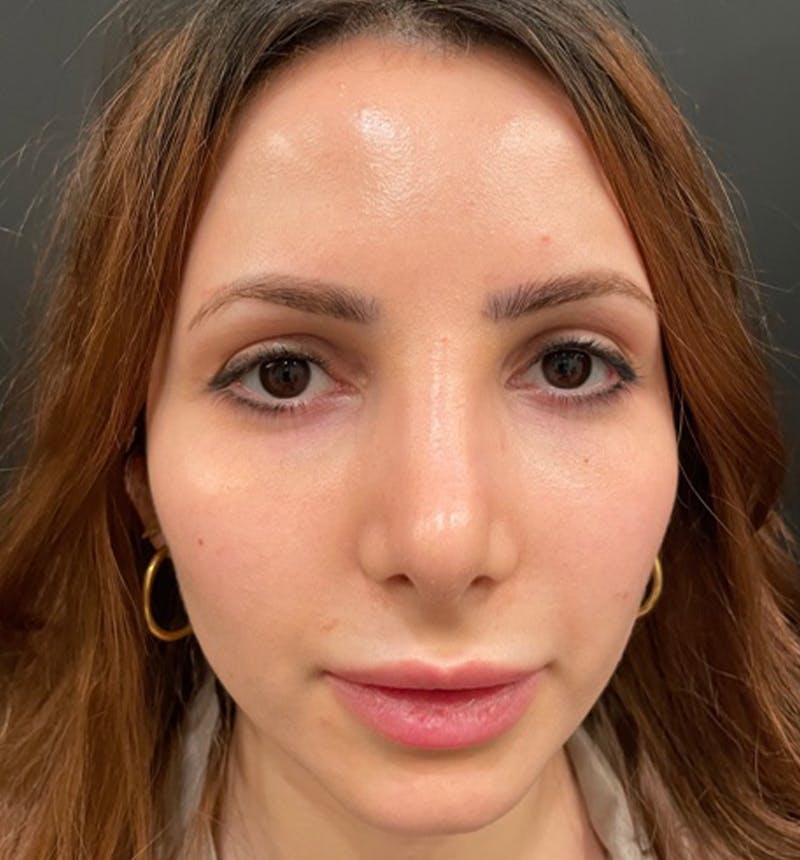 Rhinoplasty Before & After Gallery - Patient 115824 - Image 6