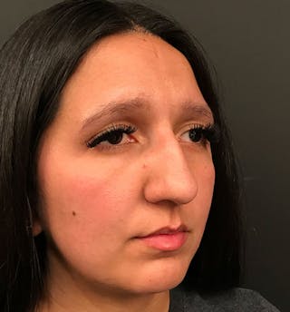 Rhinoplasty Before & After Gallery - Patient 368503 - Image 6