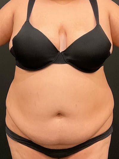Plus Size Tummy Tuck: Week After Surgery Before & After Gallery - Patient 150383 - Image 1