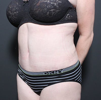 Tummy Tuck Before & After Gallery - Patient 361645 - Image 2