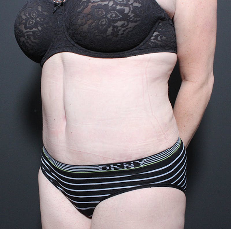 Tummy Tuck Before & After Gallery - Patient 361645 - Image 2