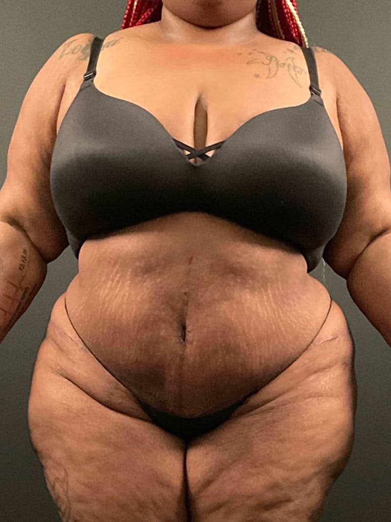 Plus Size Tummy Tuck ® Before & After Gallery - Patient 340706 - Image 2