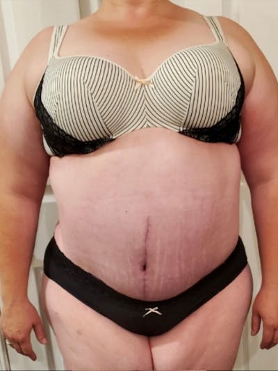 Plus Size Tummy Tuck ® Before & After Gallery - Patient 361378 - Image 2