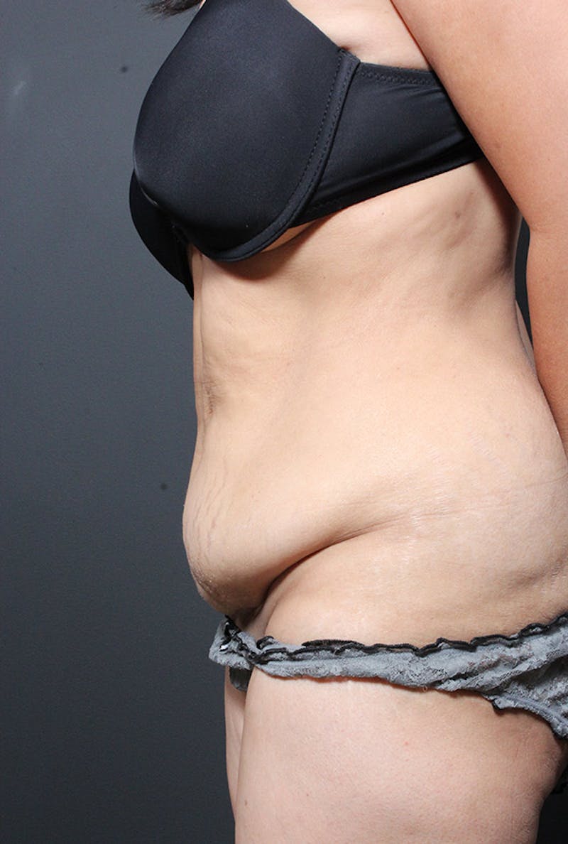 Tummy Tuck Before & After Gallery - Patient 114800 - Image 5