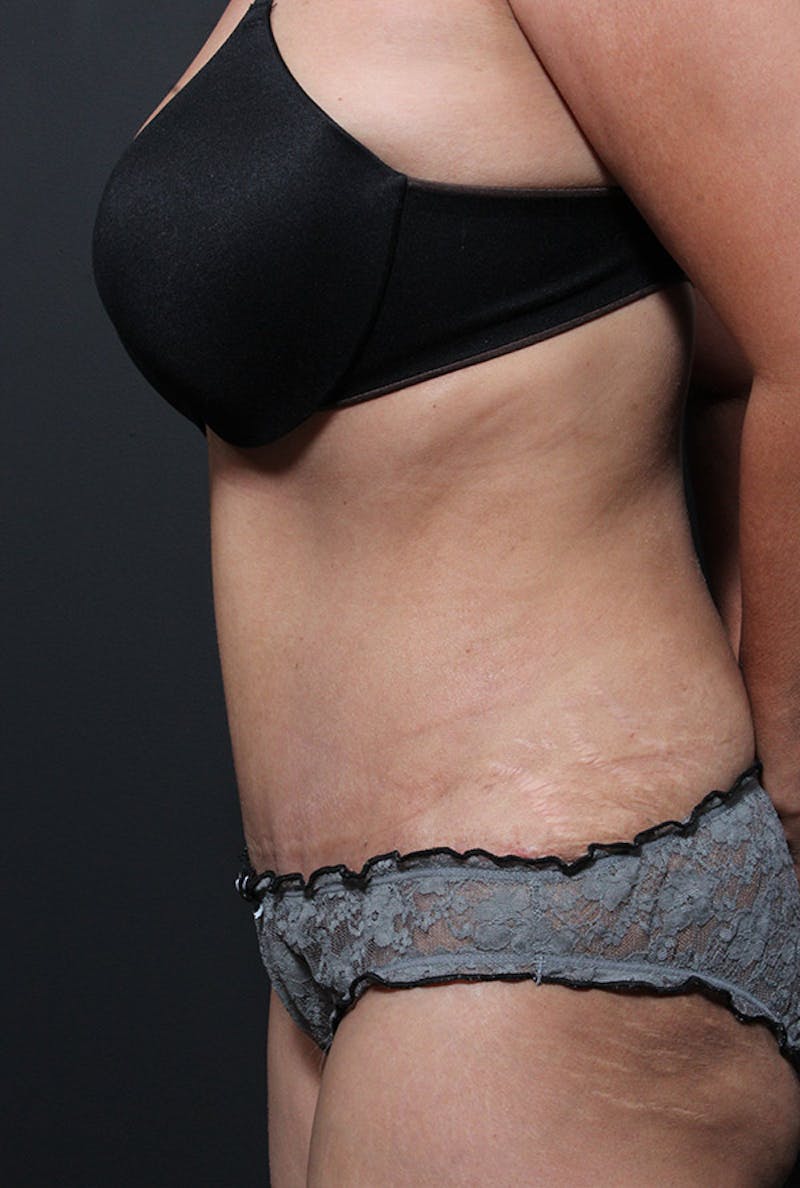 Tummy Tuck Before & After Gallery - Patient 114800 - Image 6