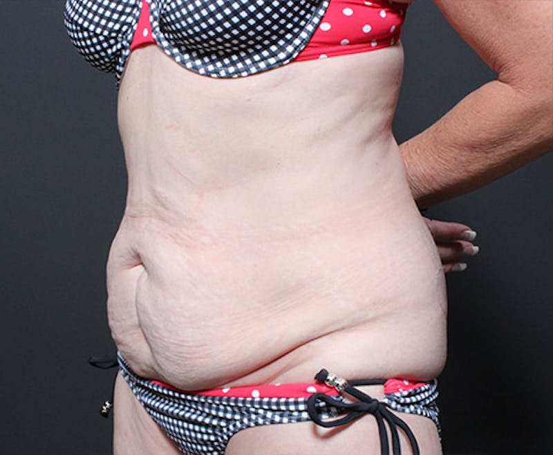 Tummy Tuck Before & After Gallery - Patient 317638 - Image 1