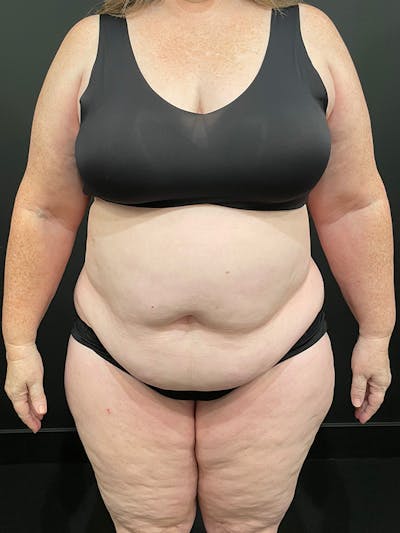 Plus Size Tummy Tuck ® Before & After Gallery - Patient 393666 - Image 1