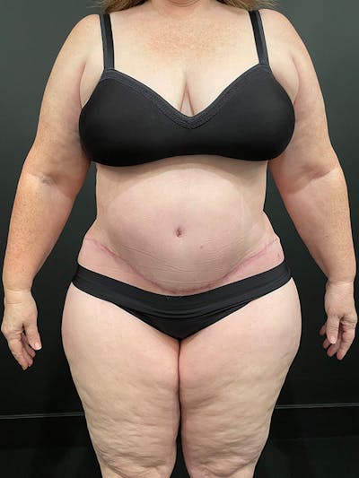 Plus Size Tummy Tuck ® Before & After Gallery - Patient 393666 - Image 2