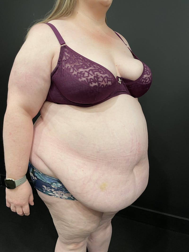 Plus Size Tummy Tuck ® Before & After Gallery - Patient 267829 - Image 3