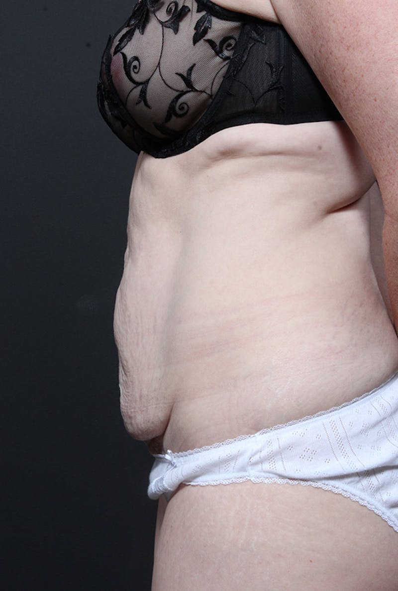 Tummy Tuck Before & After Gallery - Patient 128902 - Image 5
