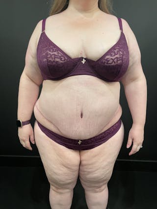 Plus Size Tummy Tuck ® Before & After Gallery - Patient 267829 - Image 4