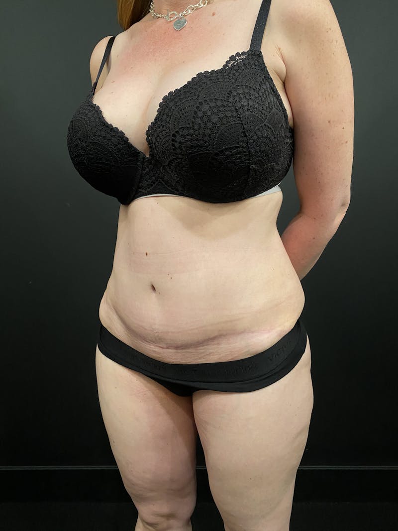 Tummy Tuck Before & After Gallery - Patient 276722 - Image 2