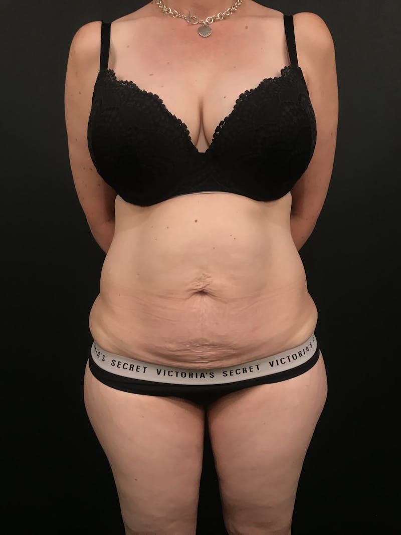 Tummy Tuck Before & After Gallery - Patient 276722 - Image 3