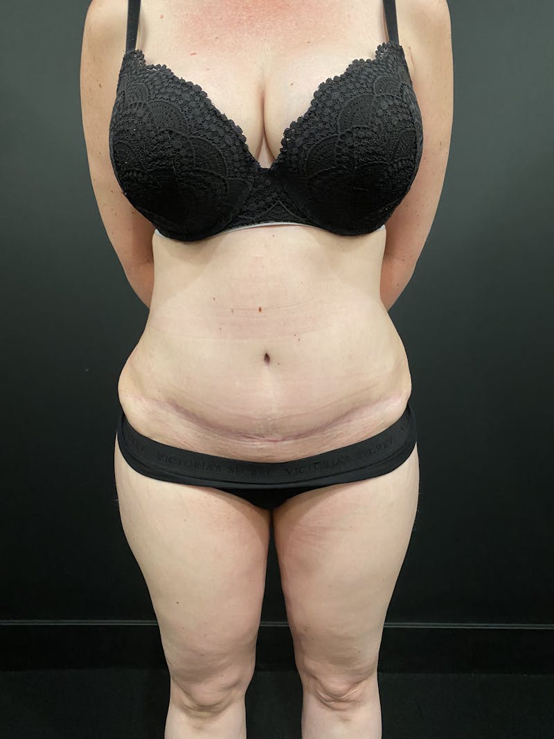 Tummy Tuck Before & After Gallery - Patient 276722 - Image 4