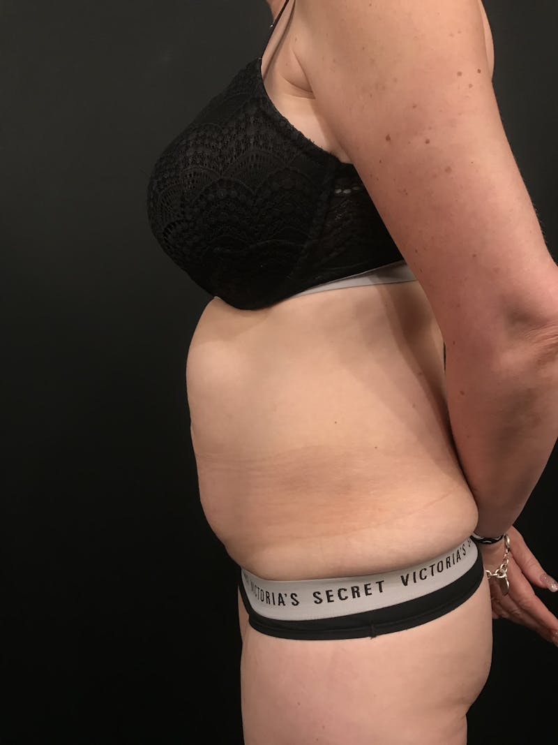 Tummy Tuck Before & After Gallery - Patient 276722 - Image 5