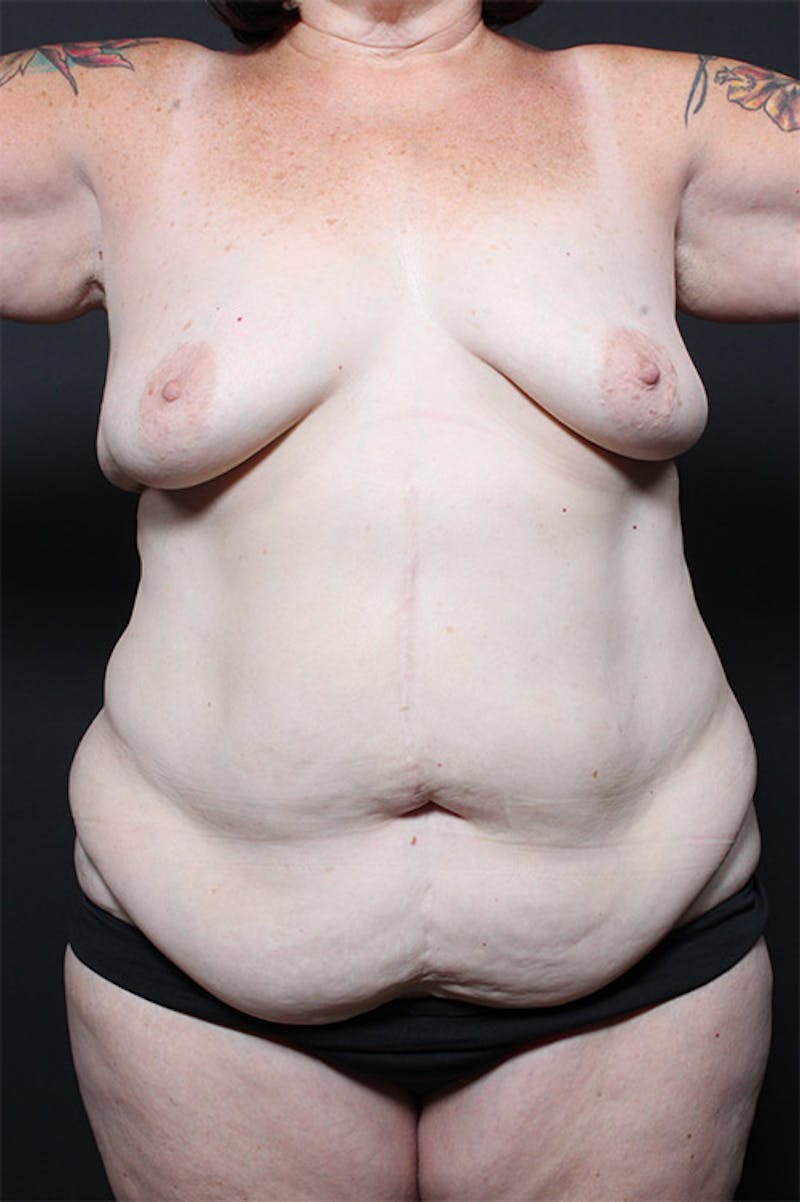 Tummy Tuck Before & After Gallery - Patient 123640 - Image 1