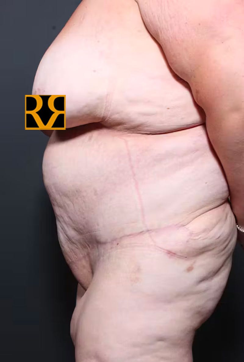 Plus Size Tummy Tuck ® Before & After Gallery - Patient 359940 - Image 6