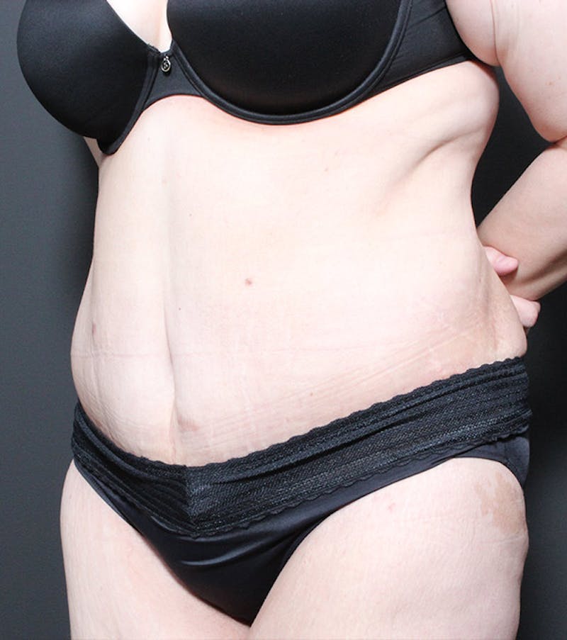 Tummy Tuck Before & After Gallery - Patient 215842 - Image 4