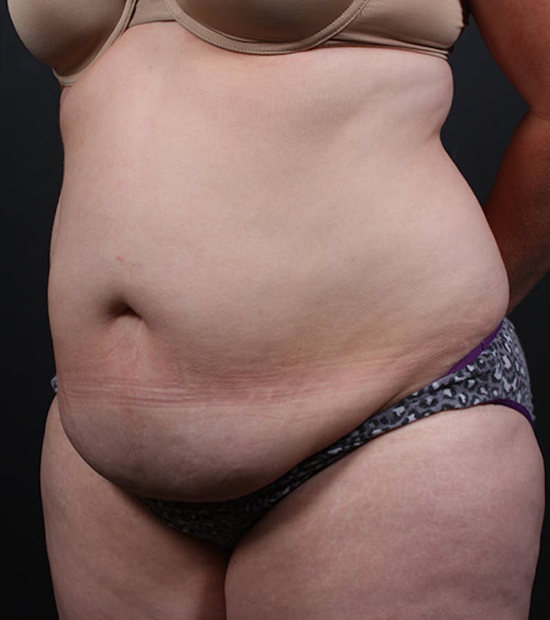 Tummy Tuck Before & After Gallery - Patient 361362 - Image 3
