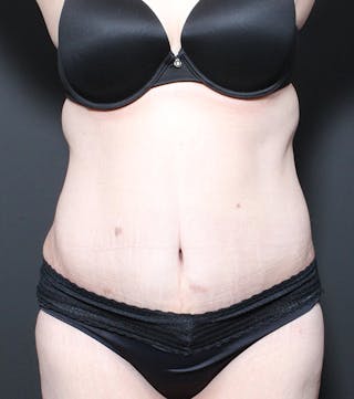 Plus Size Tummy Tuck ® Before & After Gallery - Patient 311190 - Image 2