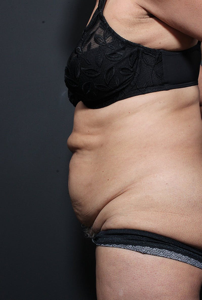 Tummy Tuck Before & After Gallery - Patient 368472 - Image 5
