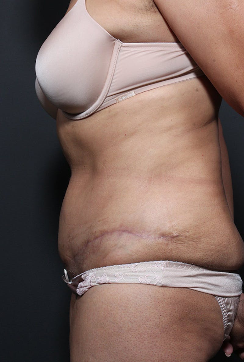 Tummy Tuck Before & After Gallery - Patient 368472 - Image 6
