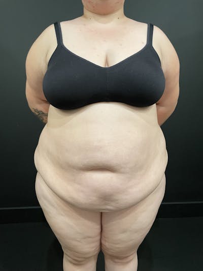 Plus Size Tummy Tuck ® Before & After Gallery - Patient 277710 - Image 1