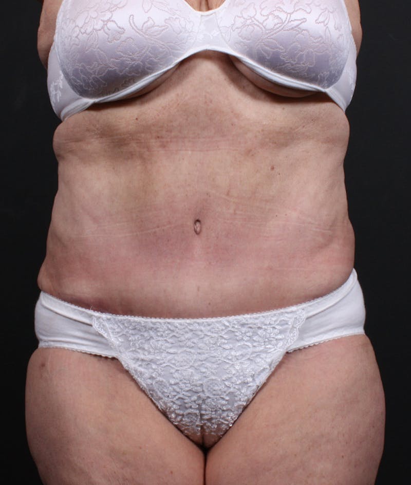 Tummy Tuck Before & After Gallery - Patient 120434 - Image 2
