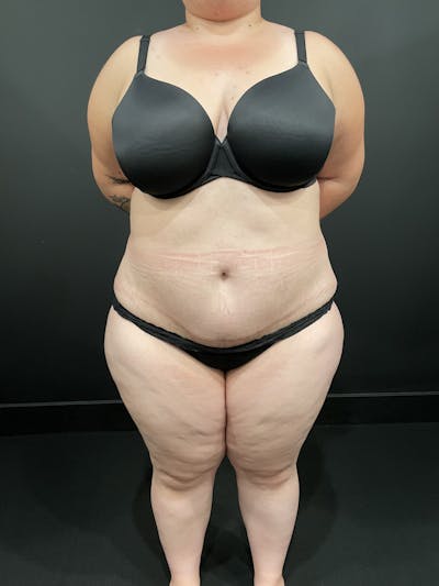 Plus Size Tummy Tuck ® Before & After Gallery - Patient 277710 - Image 2