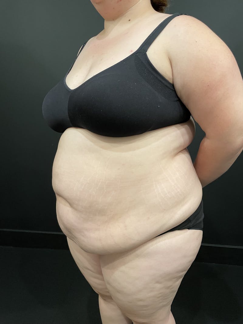 Plus Size Tummy Tuck ® Before & After Gallery - Patient 277710 - Image 7