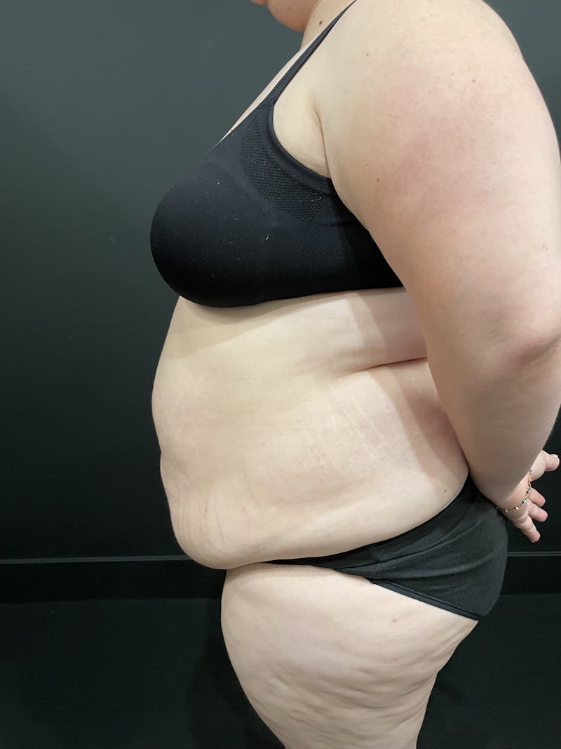 Plus Size Tummy Tuck ® Before & After Gallery - Patient 277710 - Image 9