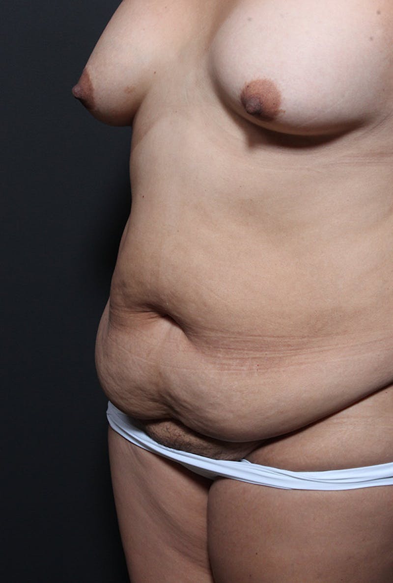 Tummy Tuck Before & After Gallery - Patient 169905 - Image 3