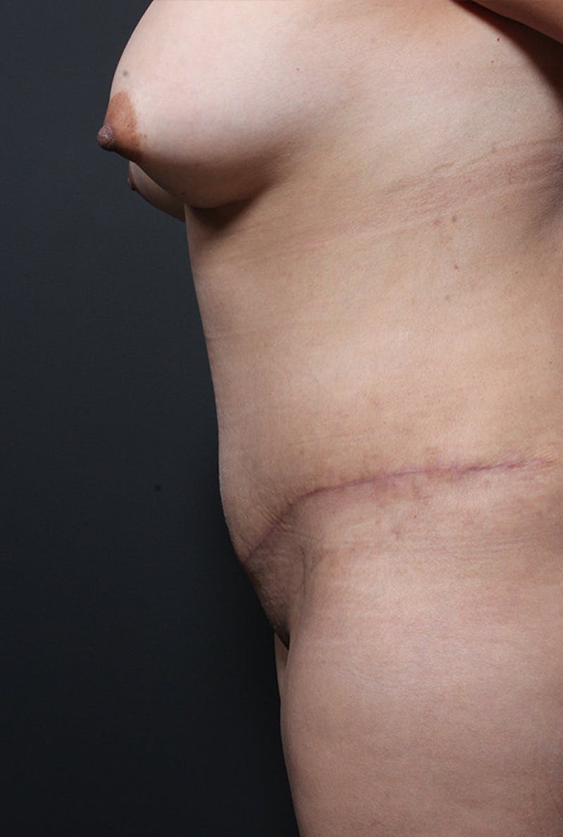 Tummy Tuck Before & After Gallery - Patient 169905 - Image 6