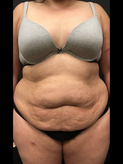 Plus Size Tummy Tuck ® Before & After Gallery - Patient 291992 - Image 1