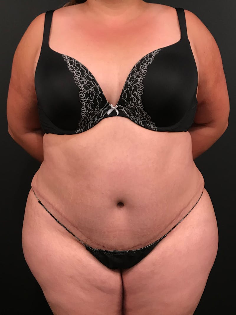 Plus Size Tummy Tuck ® Before & After Gallery - Patient 291992 - Image 2